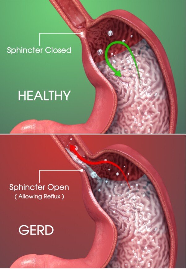 reflux-and-gerd