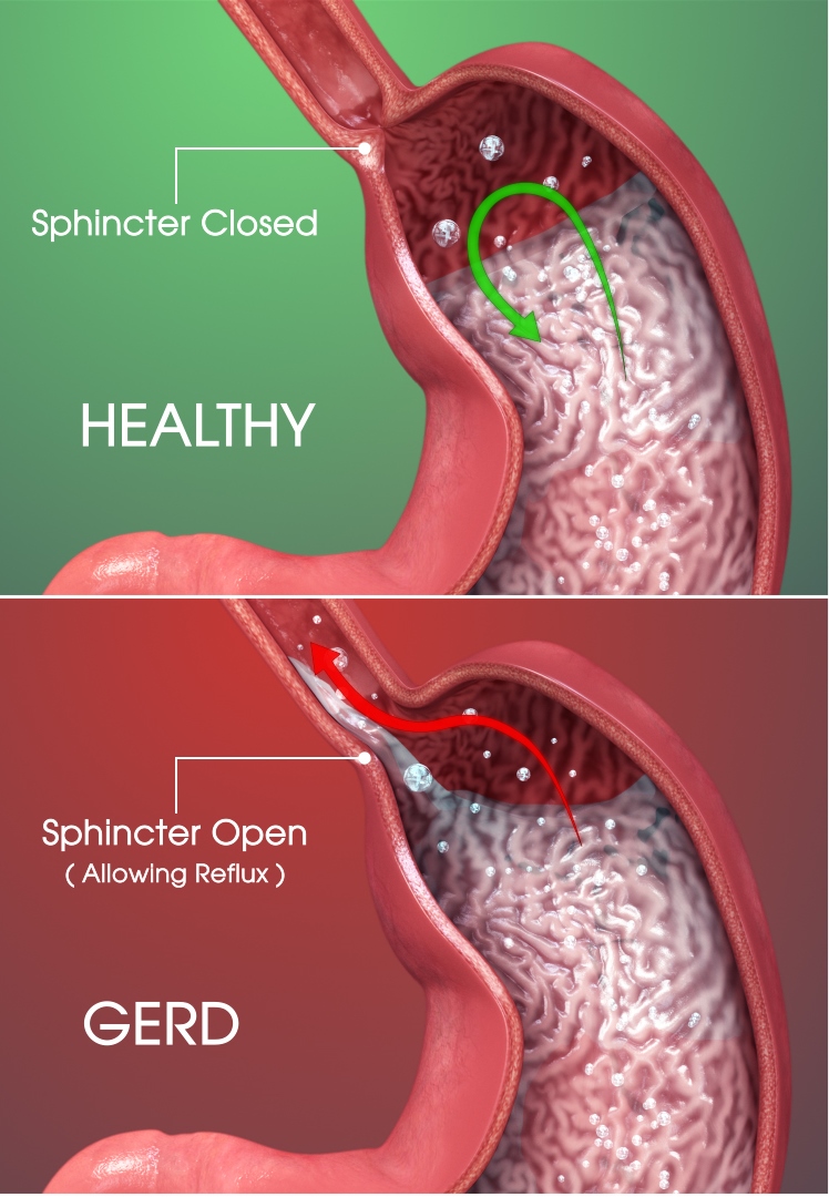 Can Gerd Make You Burp A Lot