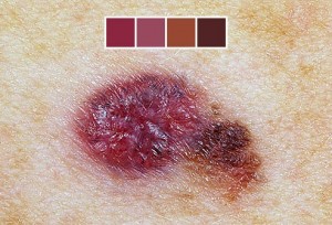 melanoma