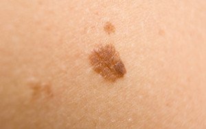 Age Spots Vs Melanoma Appearance Comparison Scary Symptoms