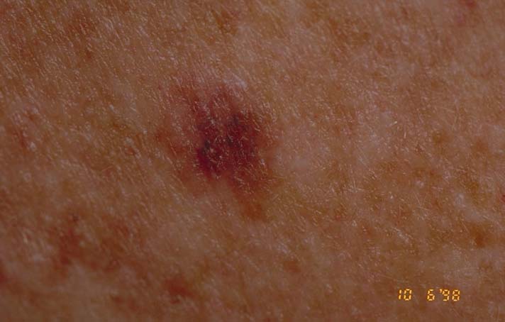 How Common Are Red Moles?
