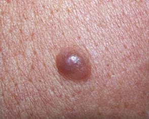 This is a nodular melanoma. Note how similar it looks to the benign mole at the top of this article. This is why any new or "What is that?" growth needs to be examined by a dermatologist.