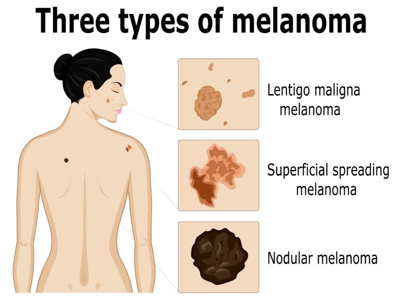 Can Bra Strap Irritation Turn a Mole into Melanoma? » Scary Symptoms