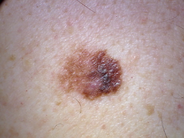 Can Itching Be the ONLY Symptom of Melanoma? » Scary Symptoms