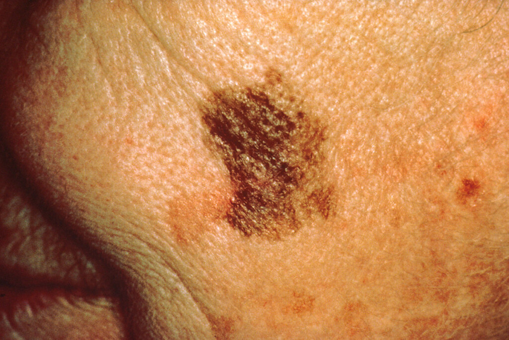 whats-the-biggest-that-melanoma-in-situ-can-grow-scary-symptoms-my