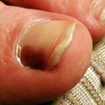 Normal Black Line Under Fingernail vs. Melanoma Streak » Scary Symptoms