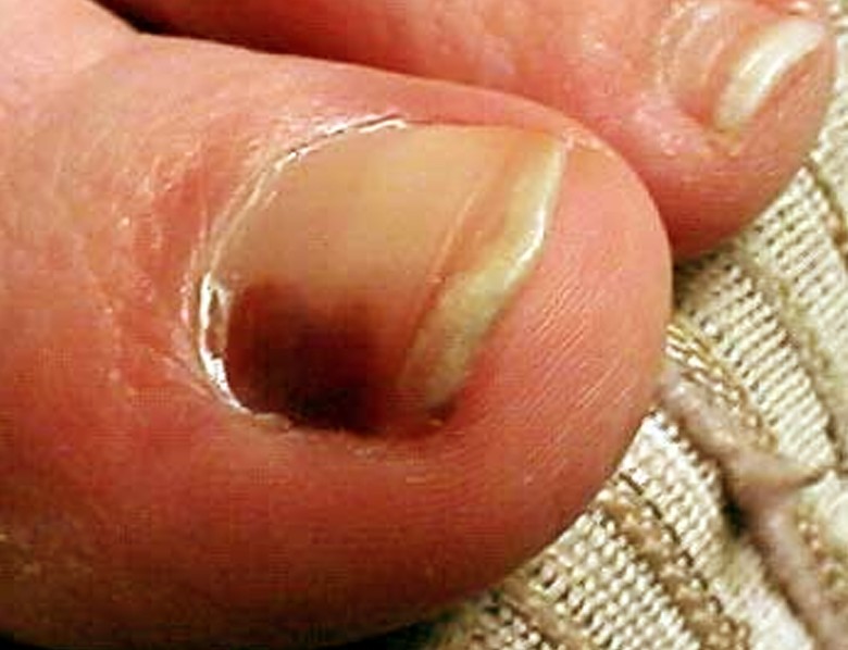 Spot toenail black under Treatment for