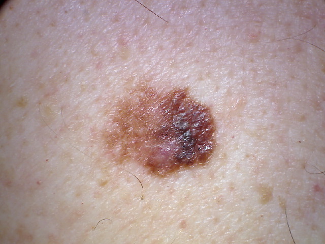 Can Itching Be the ONLY Symptom of Melanoma?