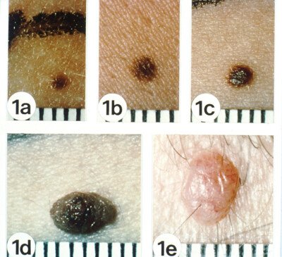 Are Flat Moles Safer than Raised or Equally Prone to Melanoma? » Scary ...