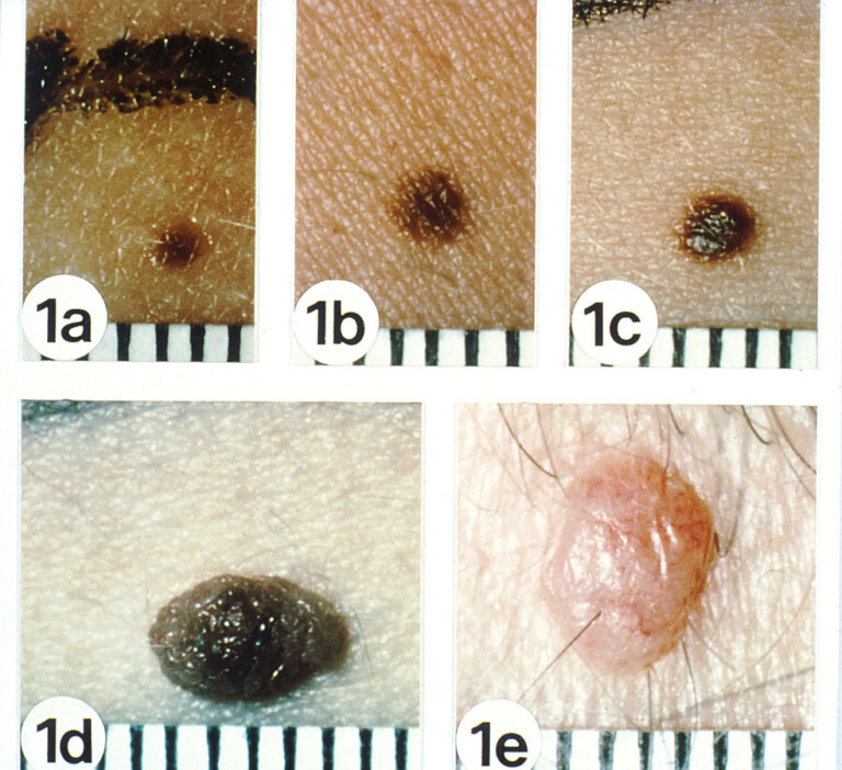 Are Flat Moles Safer Than Raised Or Equally Prone To Melanoma Scary
