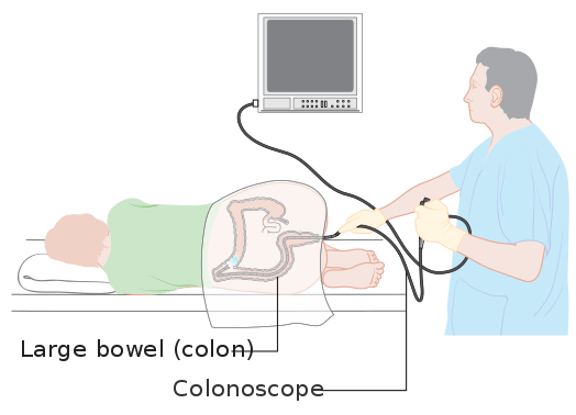 black-specks-in-stools-doctor-says-don-t-worry-scary-symptoms