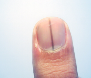 Normal Black Line Under Fingernail Vs Melanoma Streak Scary Symptoms