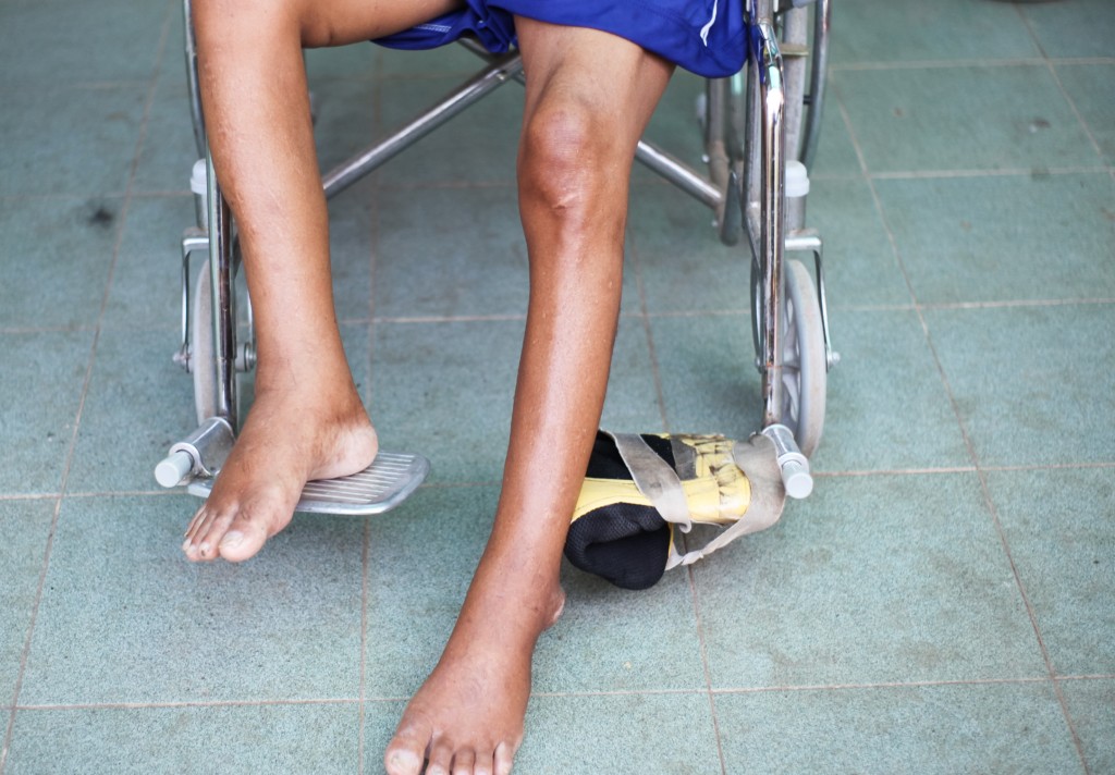Benign Calf Dent or Muscle Atrophy Your Last Article! » Scary Symptoms