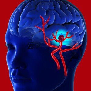 Making Brain Aneurysm Surgery Safer: No General Anesthesia » Scary Symptoms