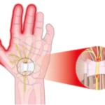 Hand Exercises After Carpal Tunnel Surgery to Regain Strength in Senio...