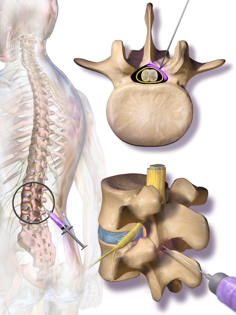 Herniated Disc Treatment: Conservative or Decompression?