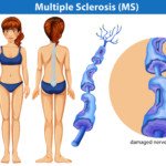 Can Twitching Muscles Be an Early Sign of MS?