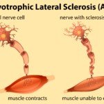 Strength Tests if You Fear ALS for Legs & Upper Body