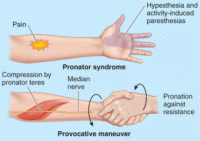 pronator syndrome pronator syndrome