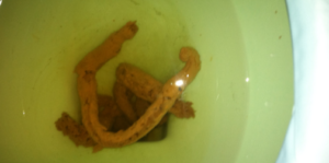 What Does Colon Cancer Poop Look Like Pictures - PictureMeta