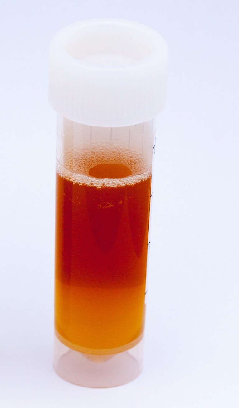 leukocytes-in-urine-during-pregnancy-2022