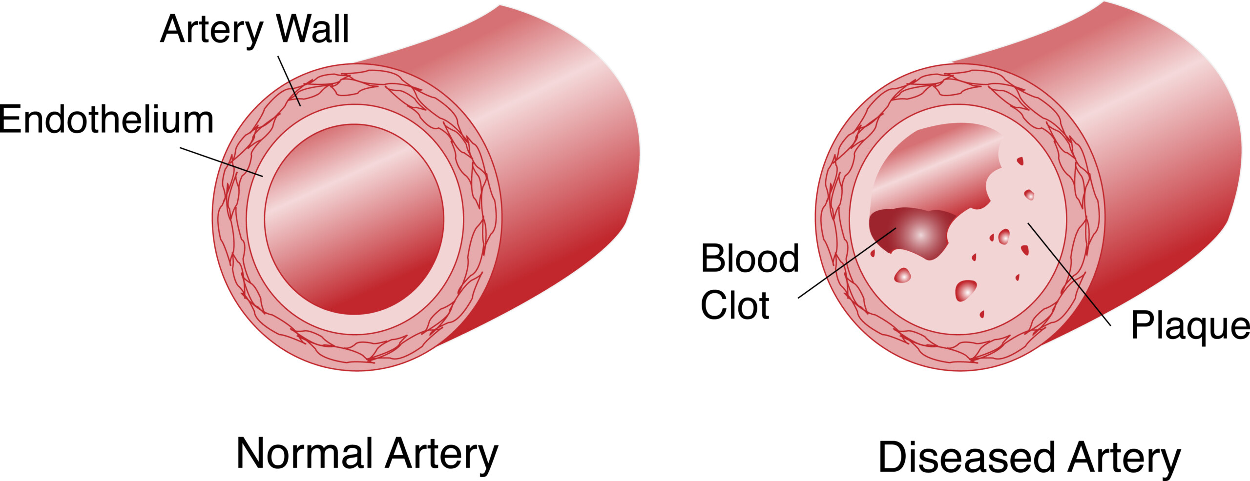 Why a Stress Test Can Miss Severe Artery Blockage