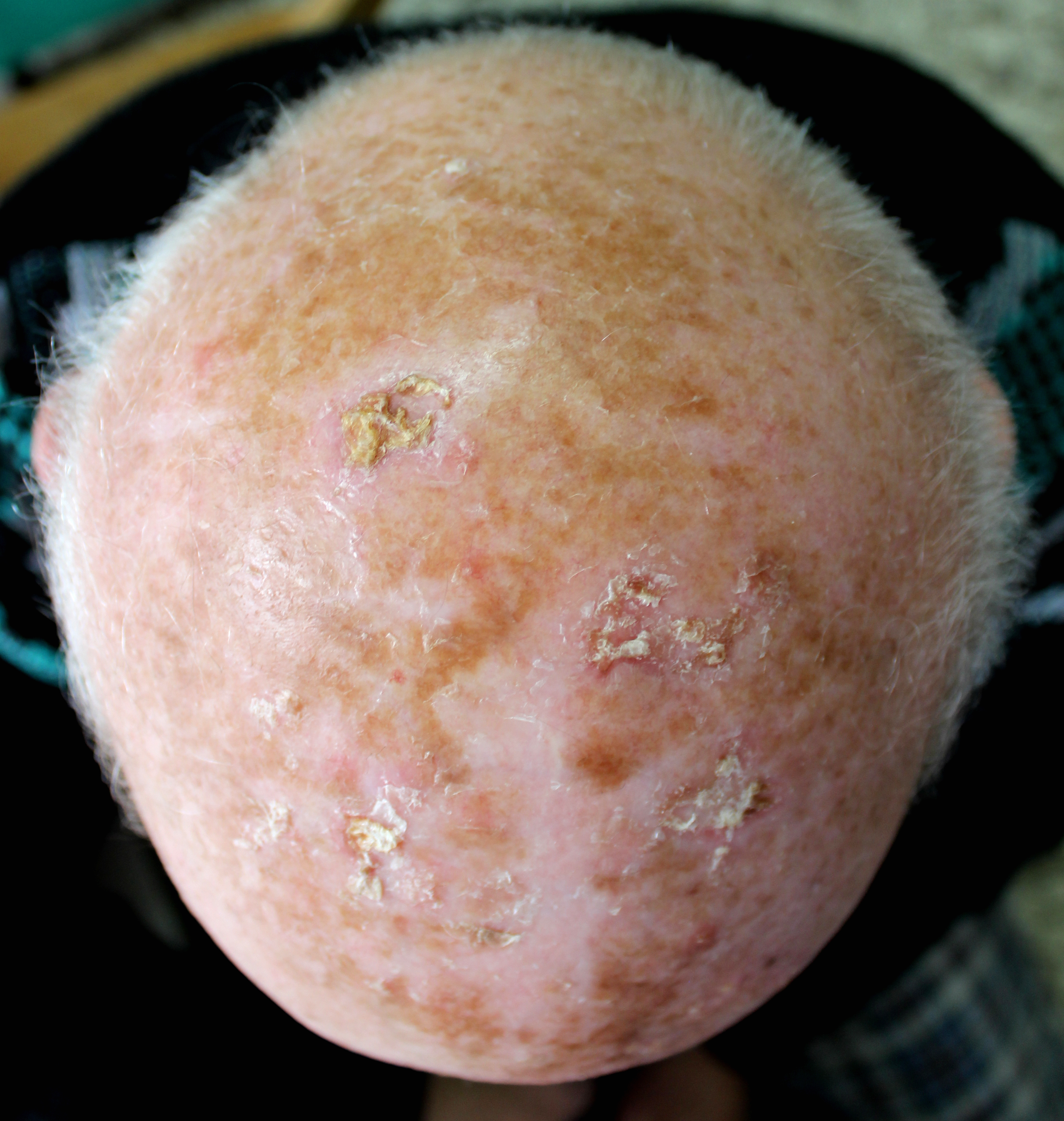 Can Scabs on Your Scalp Be Cancer?