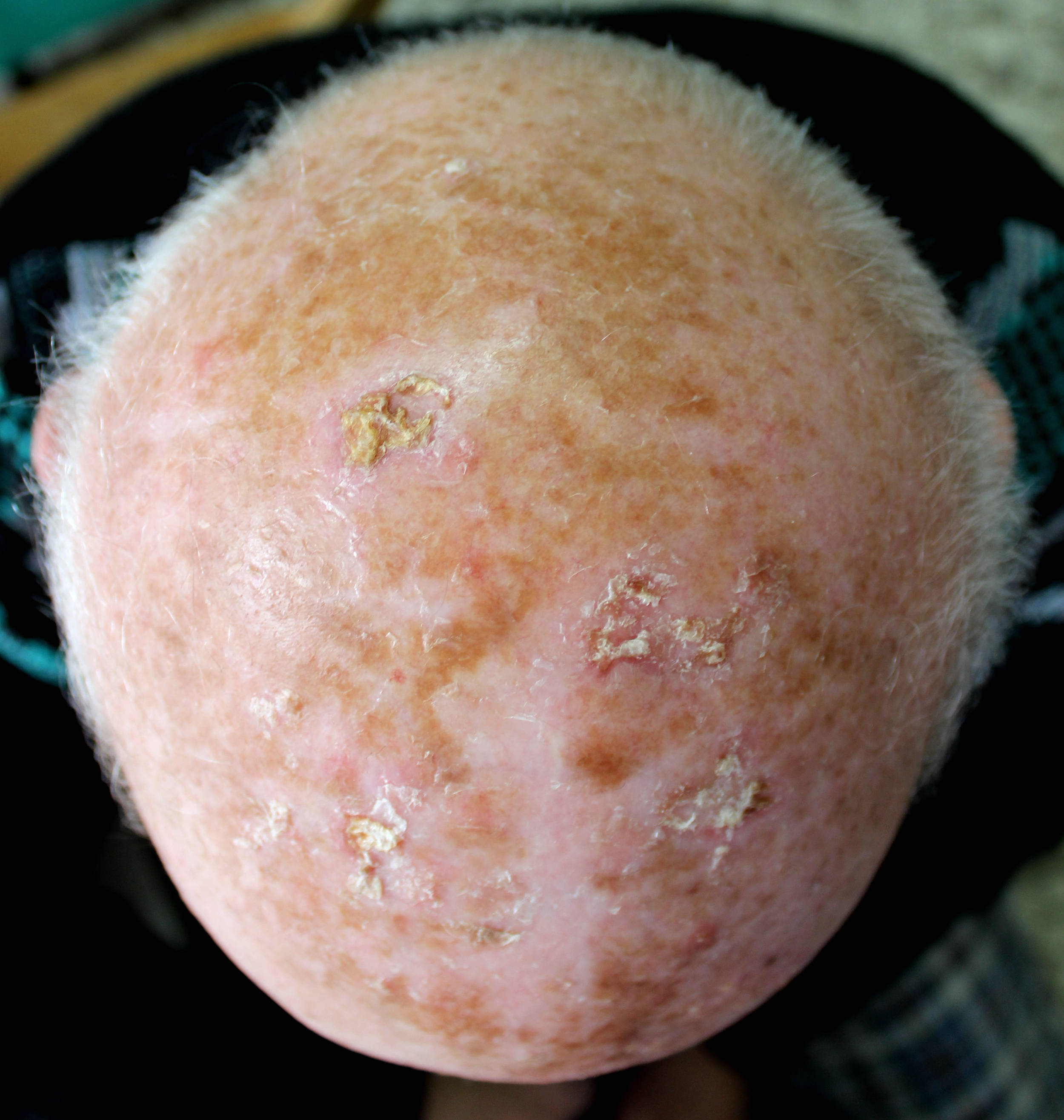 Can Skin Cancer On Scalp Cause Headaches