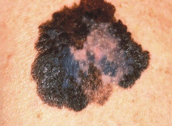 Why Is Melanoma So Hard to Treat? » Scary Symptoms