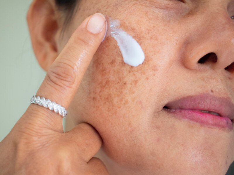 Sun Spots on Skin vs. Age Spots » Scary Symptoms