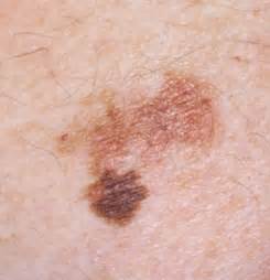 Age Spots Vs Melanoma Appearance Comparison Scary Symptoms