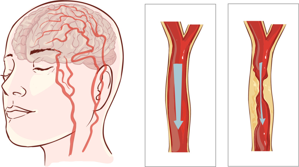 sudden-onset-transient-double-vision-get-to-er-scary-symptoms