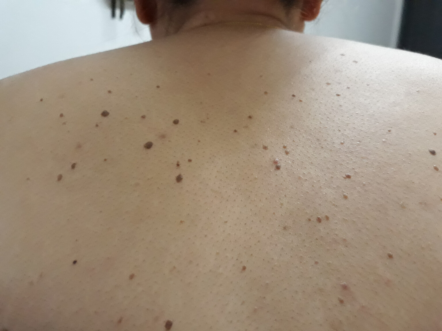 Half of Mole Suddenly Falls Off, Bleeds » Scary Symptoms