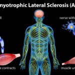 Twitching Muscle in the Thigh (Quadriceps): ALS or Benign?