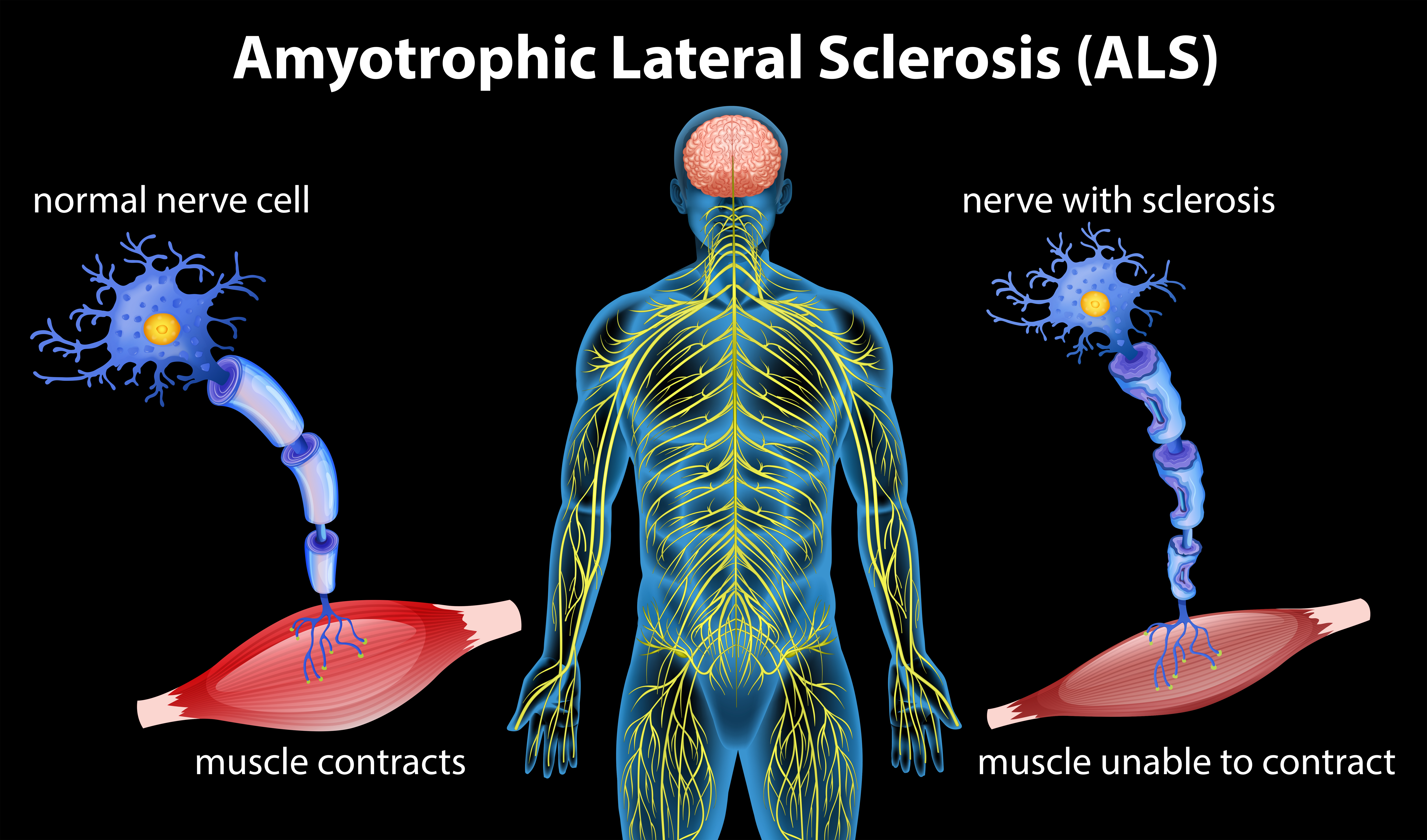 does twitching come and go in als