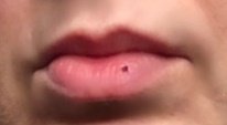 dark patch above upper lip