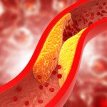 Can You Have Severe Heart Disease but Good Cholesterol Numbers?