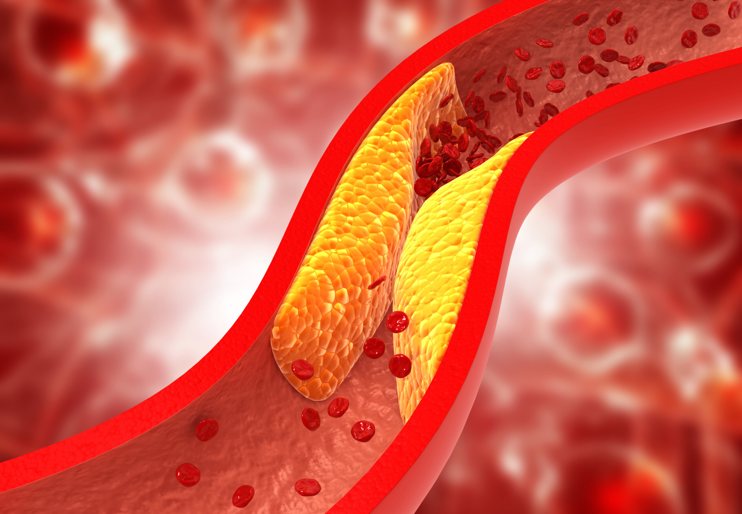 Can Two Supplements Reverse Plaque in Coronary Arteries?