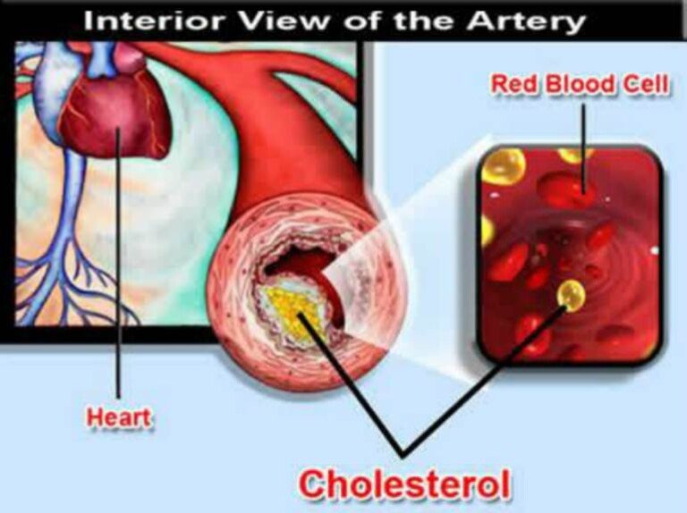 When Menopause Raises “Bad” Cholesterol Solution » Scary Symptoms