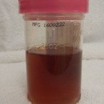 Can the Dye for a Brain Angiogram Turn Urine Brown?