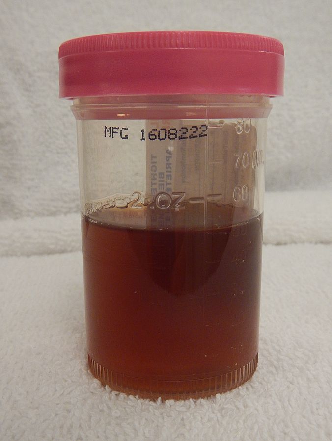 Can the Dye for a Brain Angiogram Turn Urine Brown?