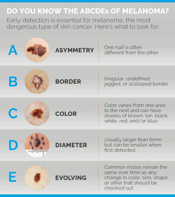 Is a Mole Normal if It’s Brown and Grey or Can It Be Melanoma? » Scary ...