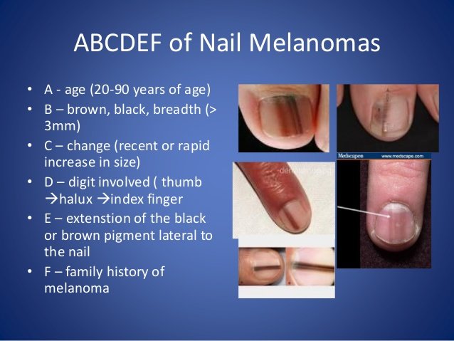 big-toenail-has-vertical-light-brown-line-melanoma-scary-symptoms