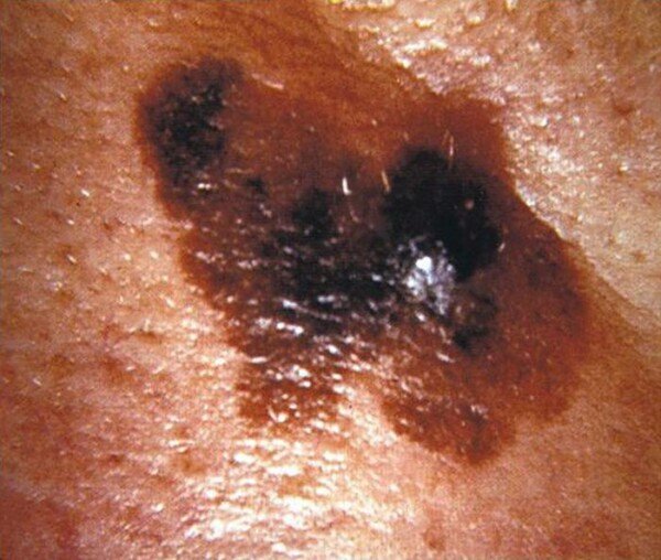 Why Is Pencil Eraser Size for Melanoma Symptoms Important… » Scary Symptoms