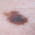 What Does Precancerous or Atypical Mole Mean?