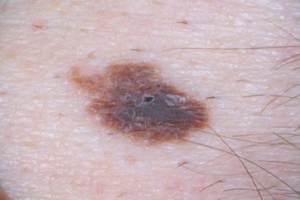 Atypical Mole