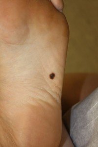 How Long Can You Have Skin Cancer Without Knowing It Scary Symptoms