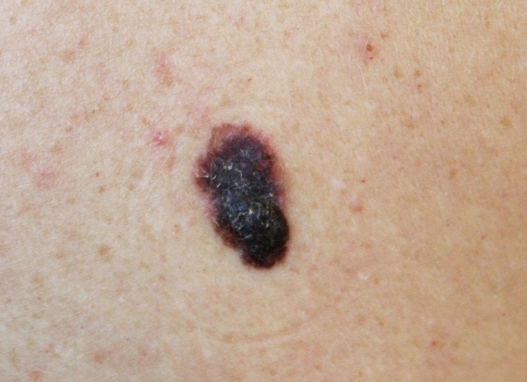 How Many Melanomas Can You Get At The Same Time Scary Symptoms