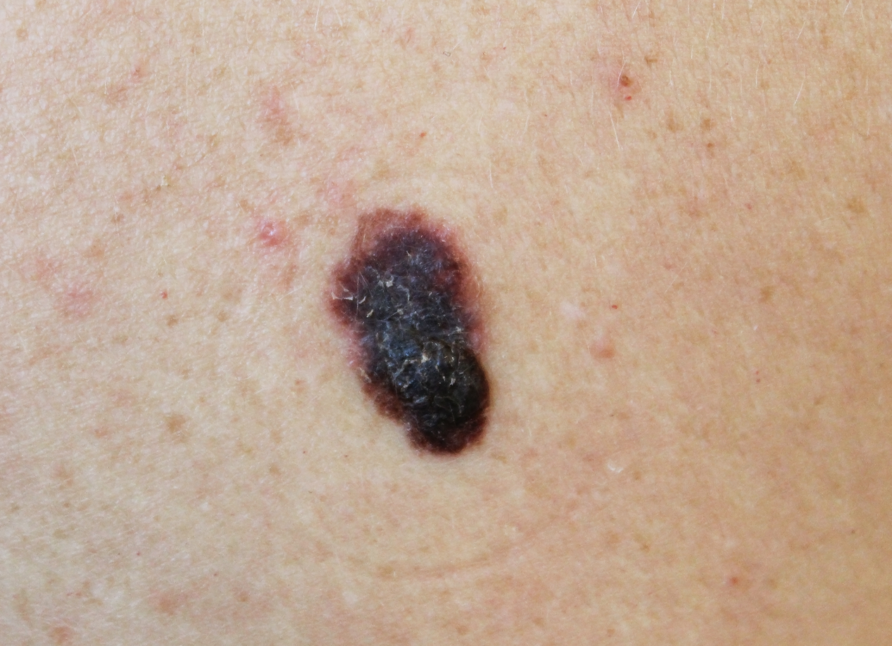 How Many Melanomas Can You Get at the Same Time?