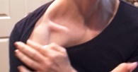 my-clavicle